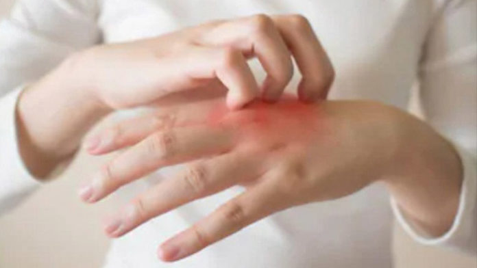 psoriaris